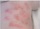 引起湿疹的原因有哪些？