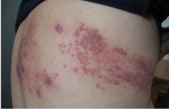 带状疱疹的症状有哪些？